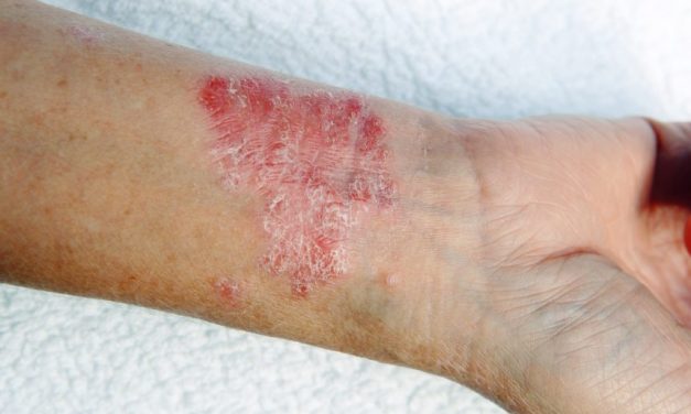Bőrgyógyász: Megtöbbszöröződött a rühös betegek száma Zentán és környékén