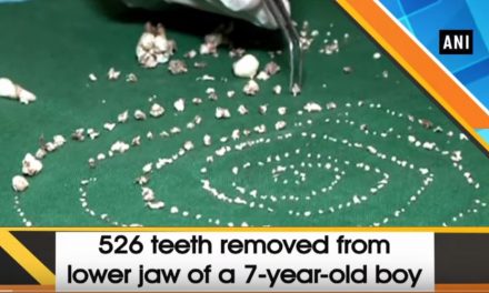 Ötszázhuszonhat fogat vettek ki egy hétéves kisfiú szájából (VIDEÓ)