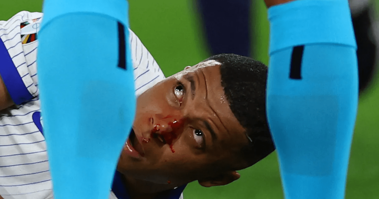 Eltörött Mbappé orra, de nem kell megműteni