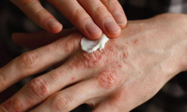 Megjelent a lepra Ausztriában