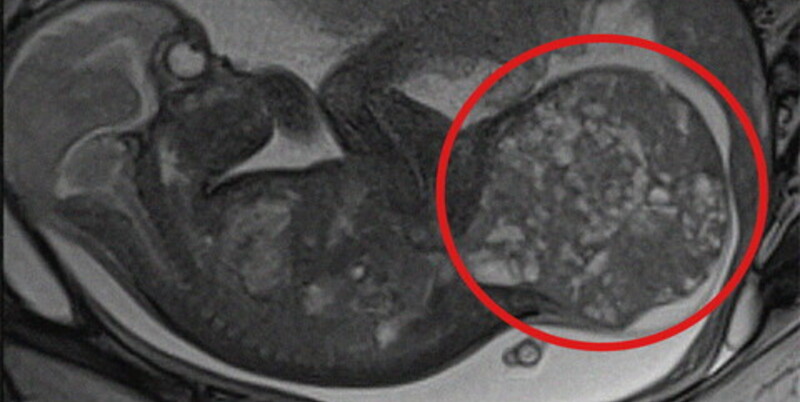 800 grammos daganatot távolítottak el egy csecsemő testéből