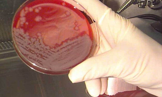 Lépfenét diagnosztizáltak egy páciensnél Magyarországon